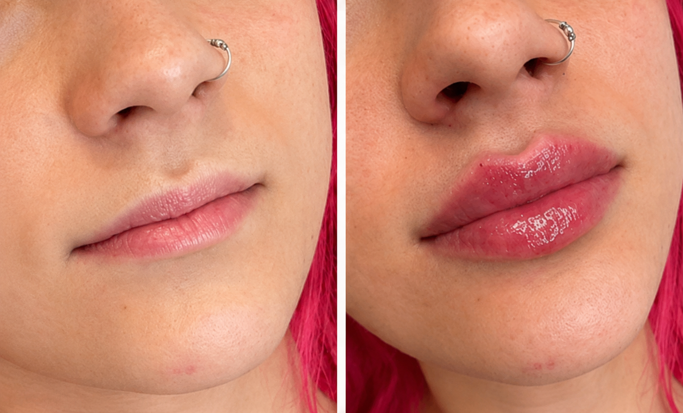 Lip filler before and after result