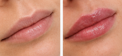 Lip enhancement before and after result