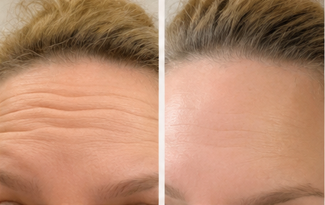 Forehead lines before and after result