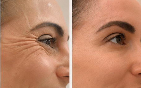 Crow's feet before and after result