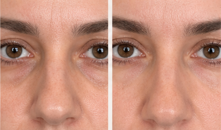 Under eye before and after result